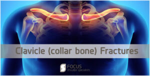 Clavicle Collar Bone Fractures Focus Shoulder