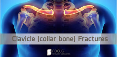 fs-collarbone-fractures