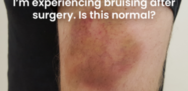 bruising