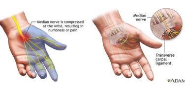 Carpal Tunnel